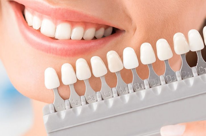 What is dental laminate and how is it done?